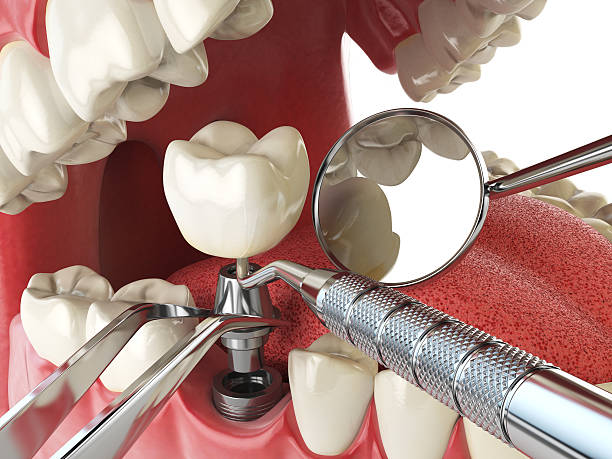 Best Emergency Tooth Extraction in Woodland Beach, MI